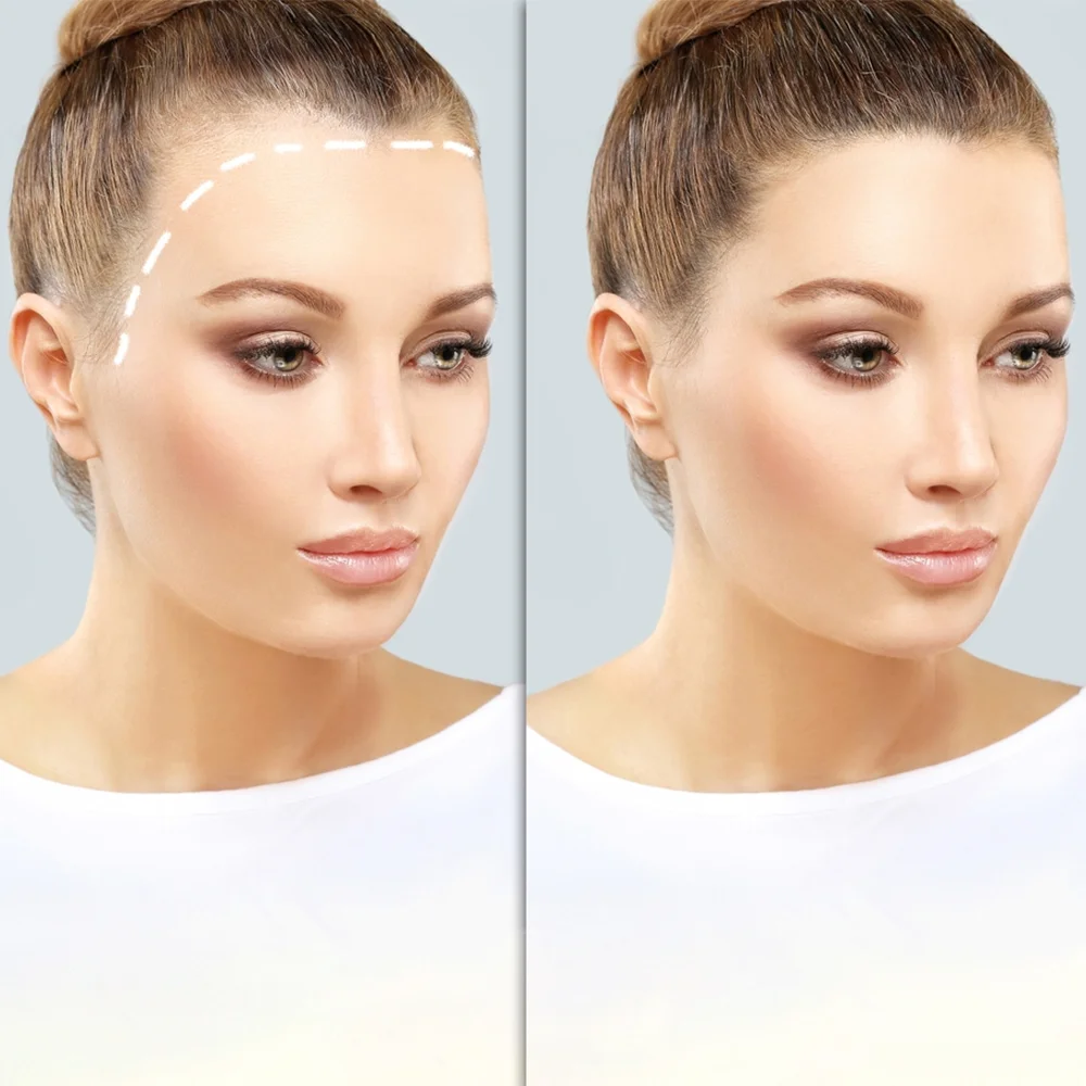 Choosing the Right Clinic for Your Hair Transplant