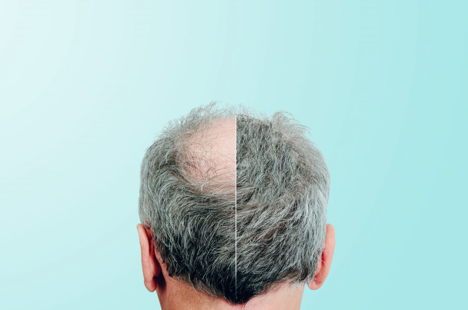 Hair Transplant UK – Westminster Medical Group®’s Patient-Focused Approach